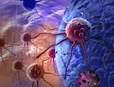 Krebszellen: noch immer ist Krebs die häufigste Todesursache